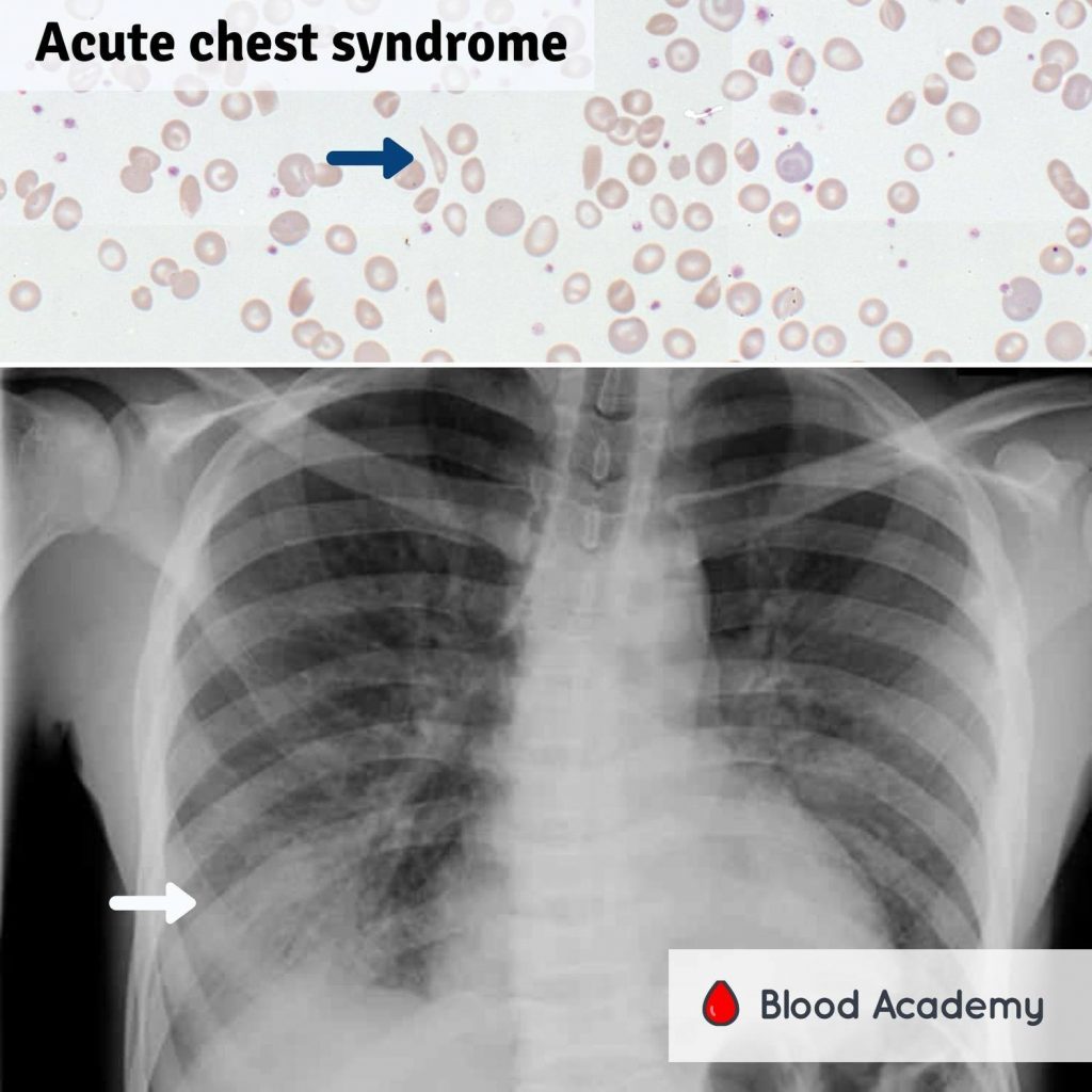 Acute Chest Syndrome (ACS)