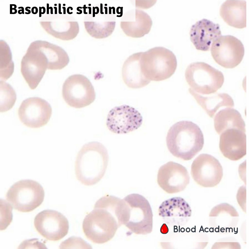 Basophilic stippling