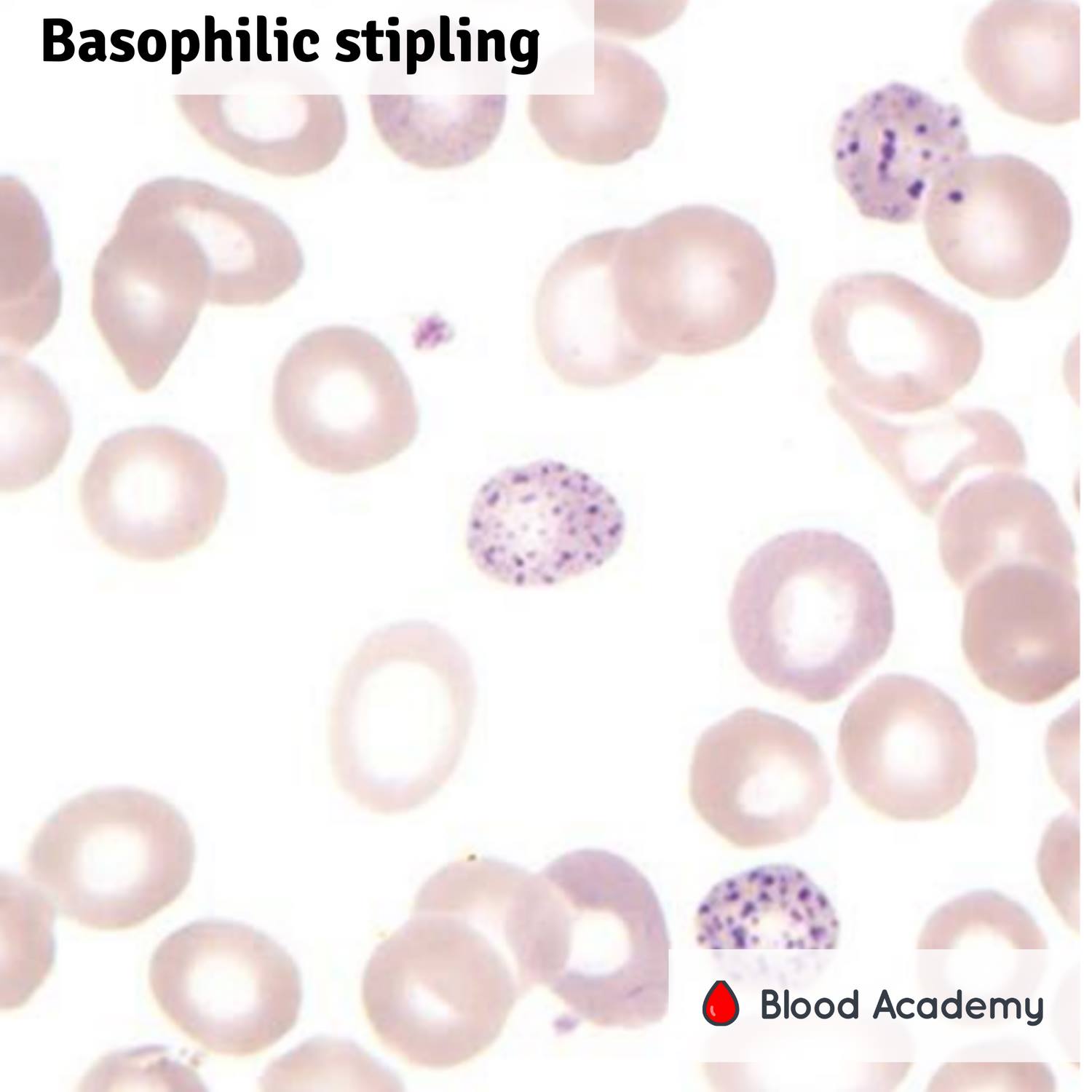 Basophilic stippling (also known as punctate basophilia) Blood Academy