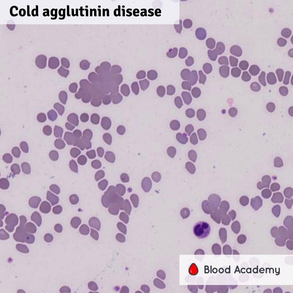 Cold agglutin disease