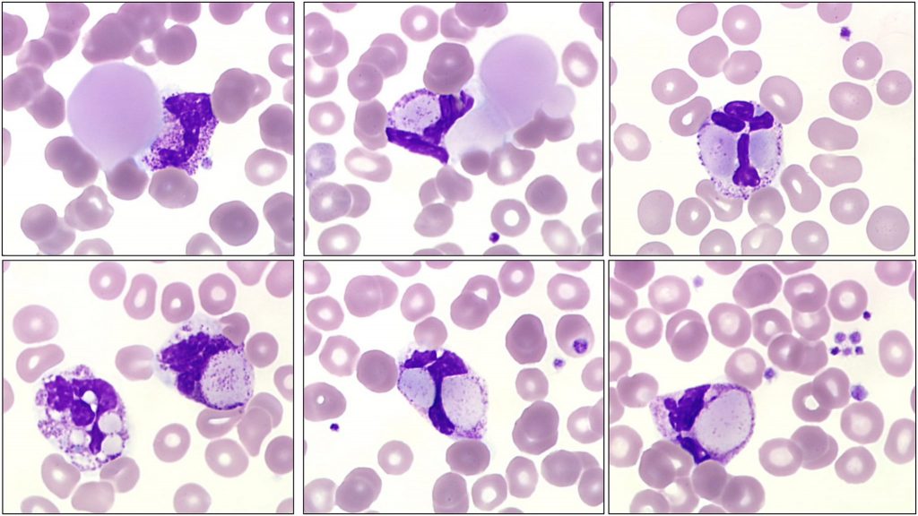 Cryoglobulinaemia