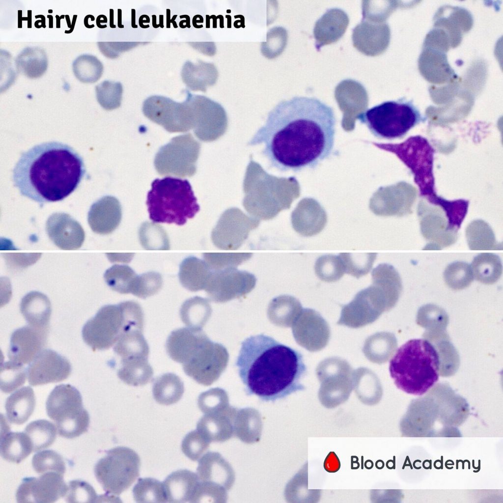 Hairy cell leukaemia