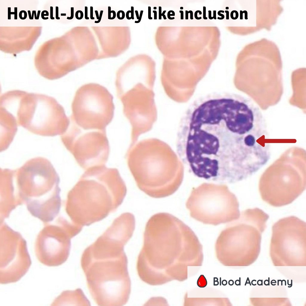 Howell-Jolly bodies in neutrophils