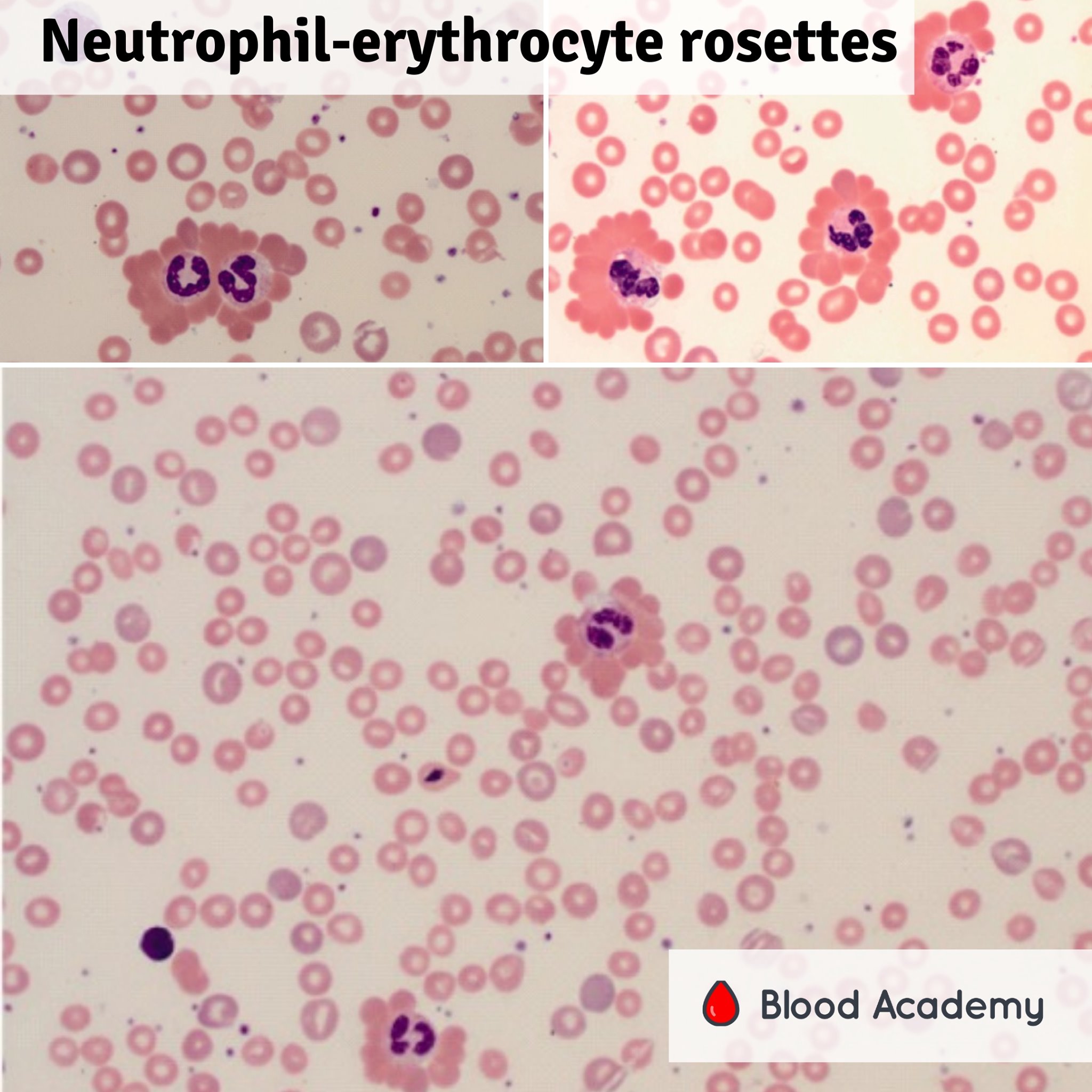 Leukocyte erythrocyte rosettes