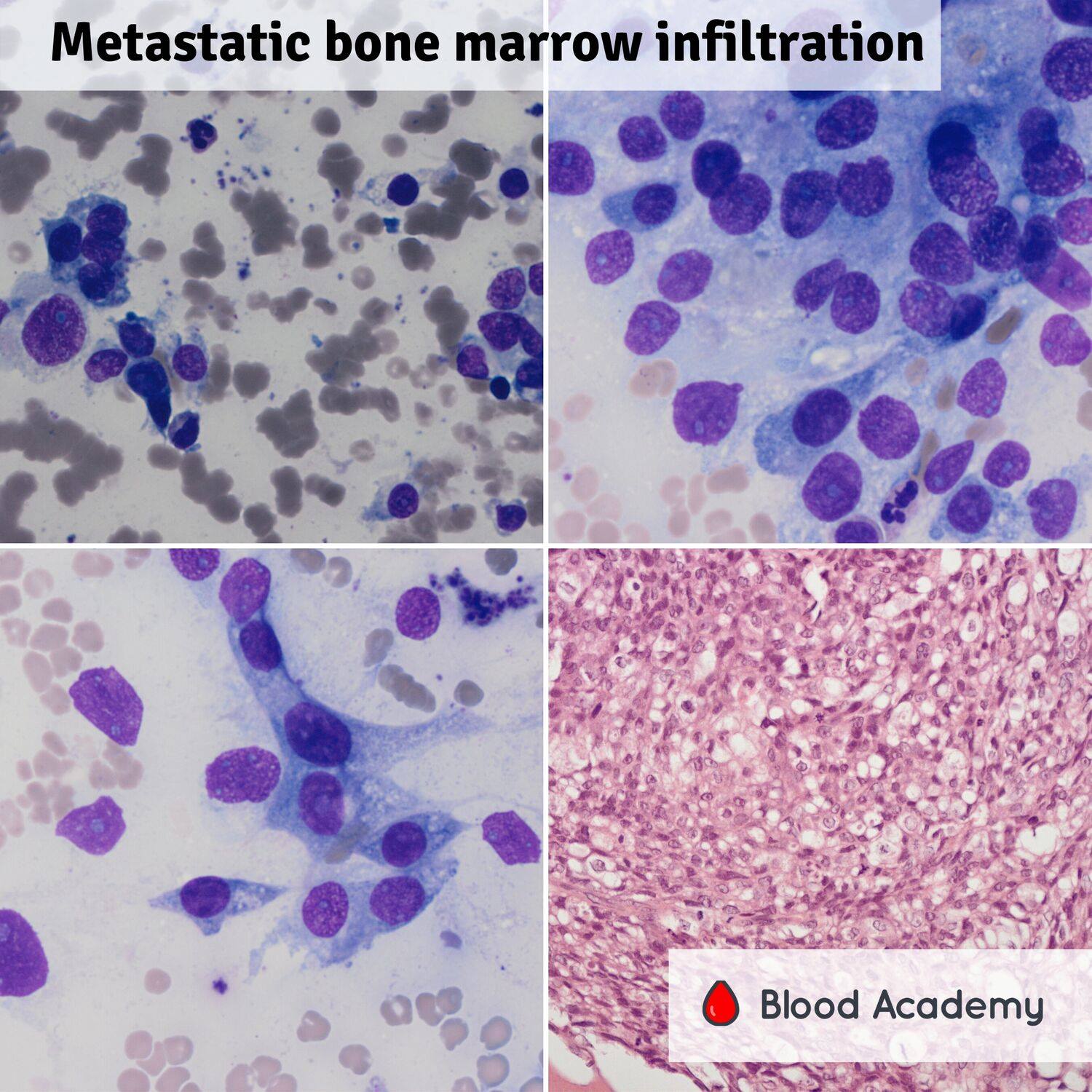 Metastatic disease