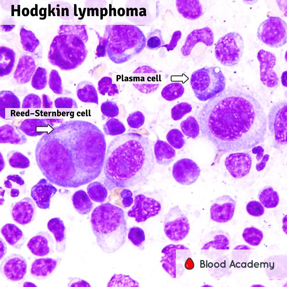 Hodgkin lymphoma