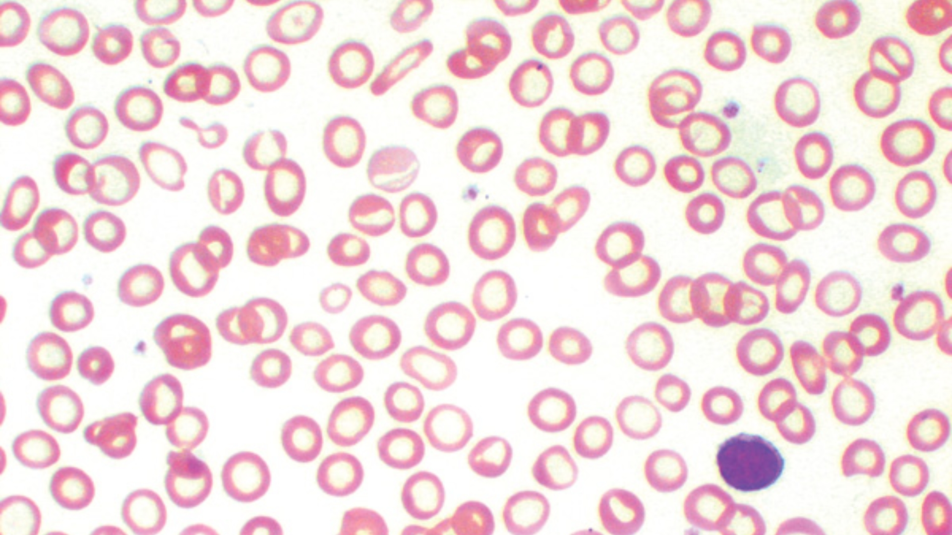CPD: The Effect of Iron Deficiency on Red Cell Indices and Morphology