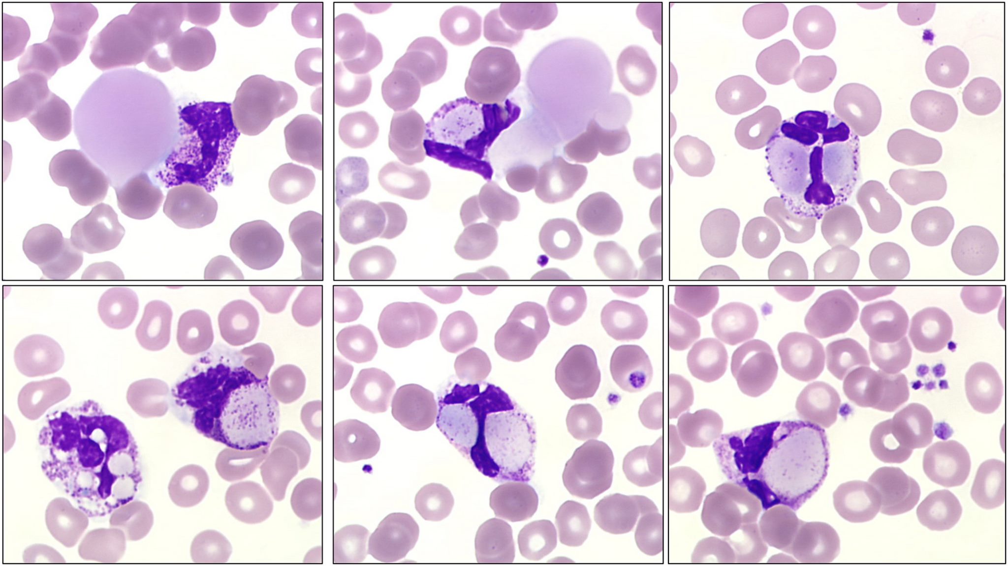 Cryoglobulinaemia blood academy