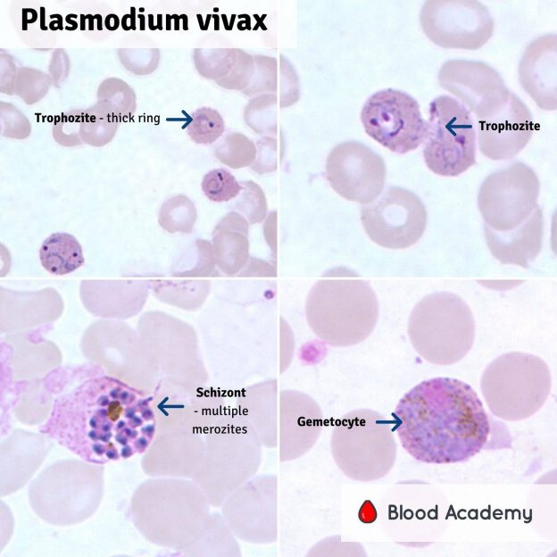 Plasmodium Vivax Blood Academy plasmodium-vivax-blood-academy